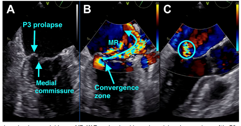 PriyaPanday27's tweet photo. In general, jets due to MVP course away from the prolapsing leaflet. Jets which arise near the LV wall, i.e., those due to commissural prolapse, sometimes course along the atrial surface of the mitral valve (“sideways MR”). When viewed in the 3 chamber view these jets can be underestimated because they are seen en face. Moreover, commissural jets arise close to the LV wall. As a result, their convergence zone is truncated. When EROA is calculated a correction factor must be used: ß/180°, where ß is the angle formed by the LV wall and the base of the convergence zone. Another pitfall in measuring EROA is failure to recognize that MR is late systolic. Since there is no MR is early systole, any MR measurement that is instantaneous, e.g., jet area, EROA, vena contracta, will overestimate MR severity. #ASEchoJC'