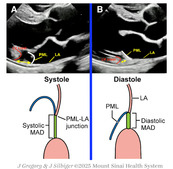 PriyaPanday27's tweet photo. The normal mitral annulus is a compact collagenous, more or less circular structure that connects the LV and LA. In contrast, the disjunctive annulus is  elongated and its length is dynamic. During systole the annulus reaches its maximal length. During diastole it recoils and decreases in length. In patients with a markedly redundant posterior leaflet, the leaflet’s base gets pressed against the LA, simulating systolic MAD. This is called pseudo-MAD. Unlike true MAD, there is no elongated separation between the LA and LV in pseudo-MAD. The increased leaflet length associated with pseudo-MAD increases MR severity. MAD is believed to be an echo marker in increased arrhythmic risk especially when it is located along the P2 scallop. In addition, the circumferential extent of MAD may increase MR. #ASEchoJC