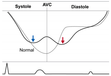 PriyaPanday27's tweet photo. Arrhythmic MVP is associated with ventricular arrhythmias and in some cases sudden arrhythmic death. Echo findings which are associated increased arrhythmic risk include: bi-leaflet prolapse, thick long leaflets, MAD length > 8.5 mm, Picklehaube sign, curling, severe MR. Strain findings include: the double peak sign and mechanical dispersion. #ASEchoJC