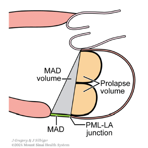 PriyaPanday27's tweet photo. When MAD and MR are present in patients with MVP, some of the blood that might otherwise be ejected into the aorta and regurgitated into the LA instead expands the (potential) space between the LV crest and PML-LA junction (MAD volume) as well as the potential space contained within the mitral valve (prolapse volume. Since these volumes are retained in the LV they contribute to LV volume overload apart from the contribution of MR volume. The increase in LV end-diastolic volume resulting from MAD and prolapse volumes might account for what some authors attribute to MVP-related cardiomyopathy. #ASEchoJC