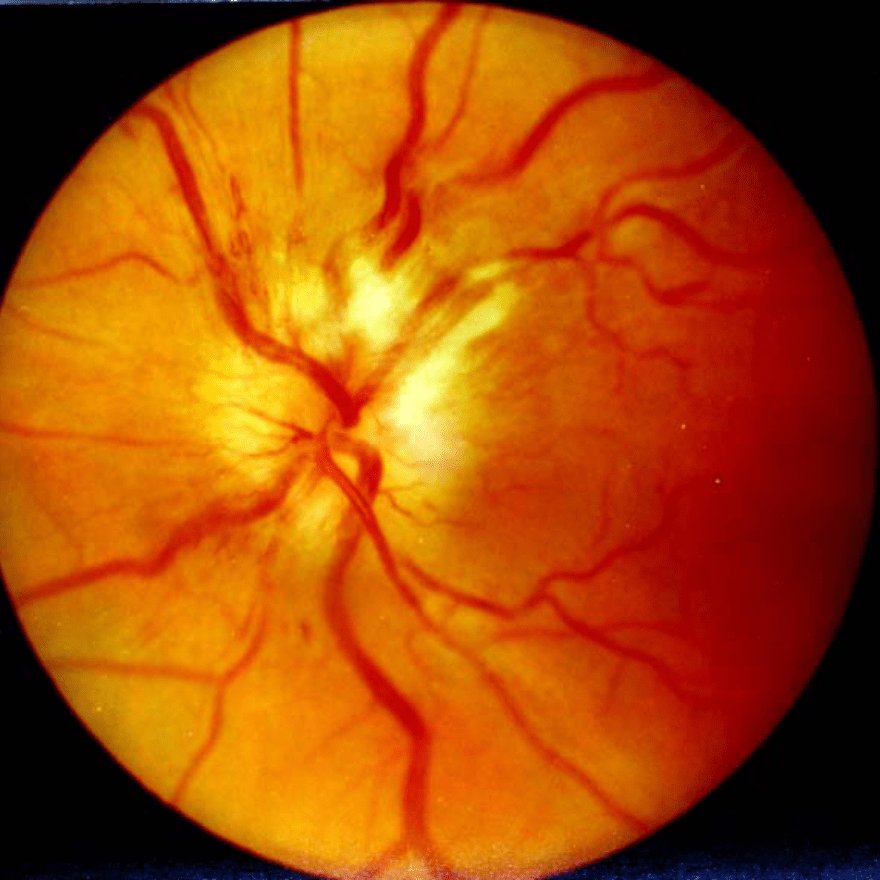 MTDMED's tweet photo. ⚠️ Which anti-tuberculosis drug is associated with optic neuritis? https://t.co/ycCiVY4G99