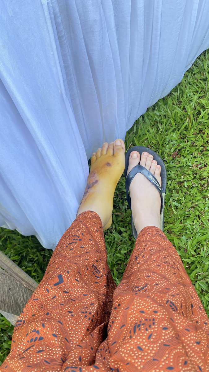 nothappypeople1's tweet photo. jadi bridesmaid , tapi gabisa jalan guys https://t.co/2kx9f2ySXQ
