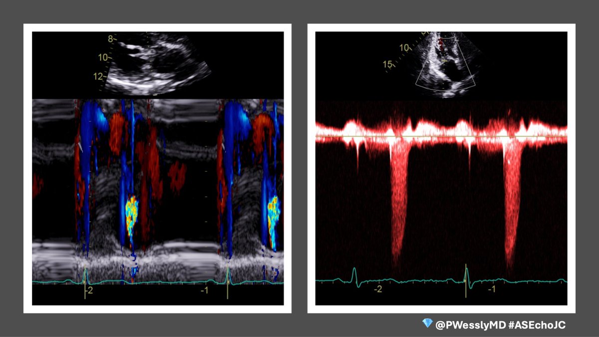 PWesslyMD's tweet photo. 💎 MR Timing matters.
⚠️ In late-systolic MR, EROA reflects only the peak moment of regurgitation.
🫀 Regurgitant volume often better reflects the true MR burden because it accounts for the entire systolic period.
#ASEchoJC #EchoFirst #CardioTwitter #MVP @ASE360 @JournalASEcho