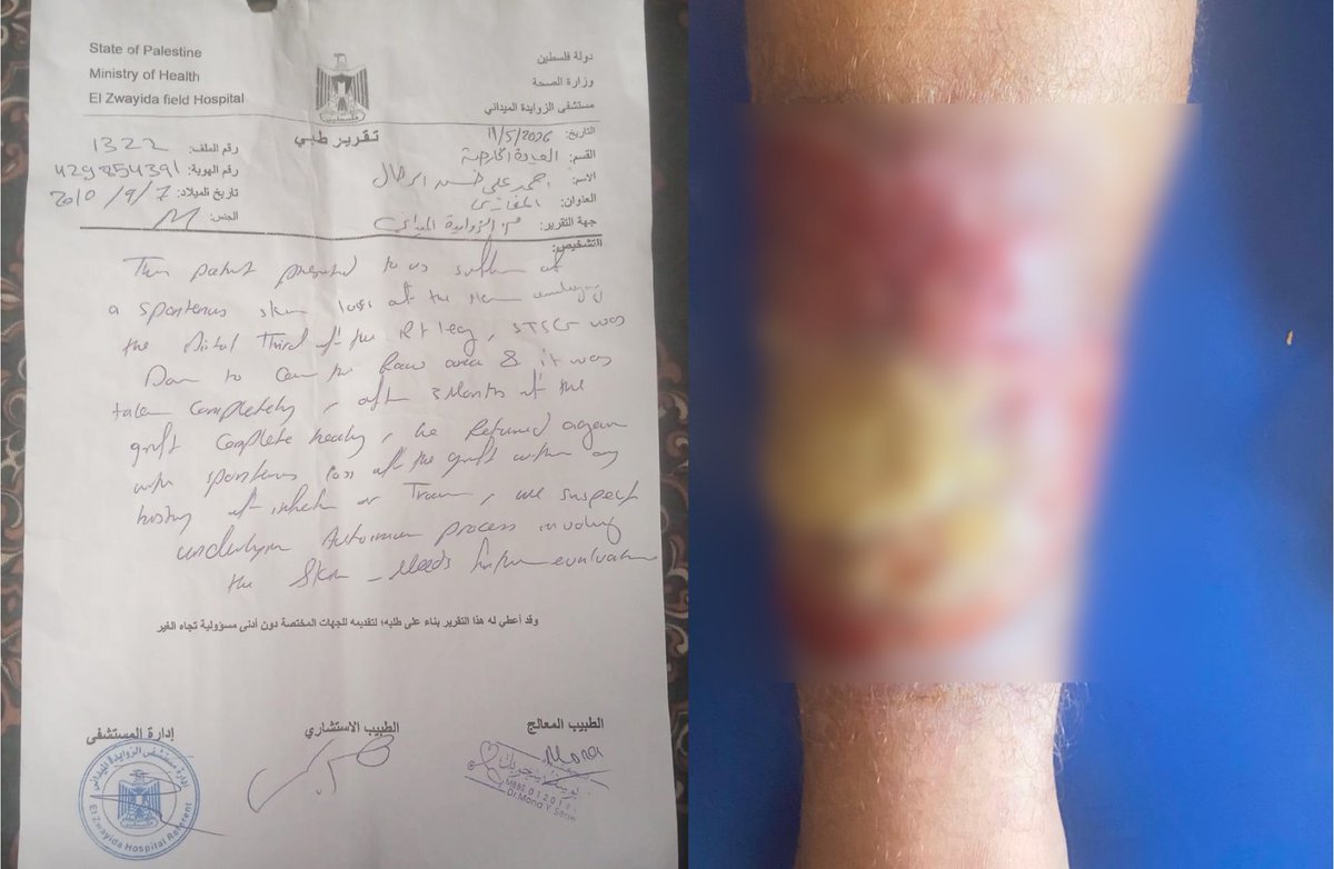 zesqyb's tweet photo. Ahmad (15) is at imminent risk of leg amputation if he isn't treated soon.

He was injured in a bombing over a year ago, and his wound has never properly healed due to repeated displacement and lack of affordable medical care.

His situation is critical.
🔗https://t.co/DZ1jG1Jiql