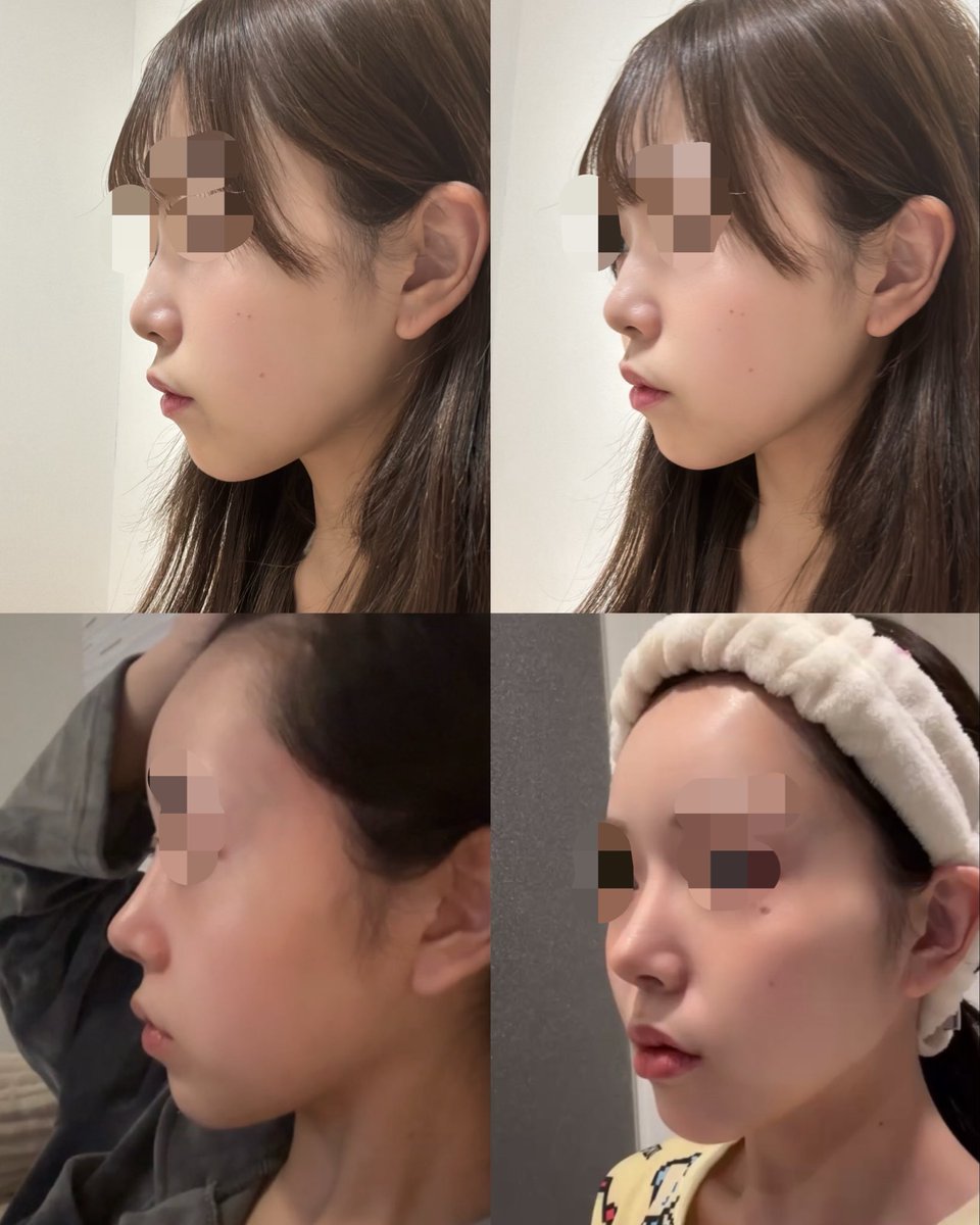 nya3_chu's tweet photo. 鼻は結局骨切りたいキッカケになったから修正するんだろうけど今もすごく変化あって満足🌻🌟🫶⭐️ https://t.co/ombVgw9LmP