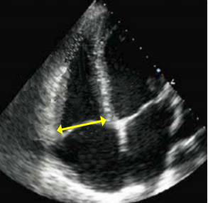 AppCardioNova's tweet photo. 3/
📏 VD: tamaño y pared
Diámetro basal VD:
🟢 <41 mm
🟡 41–44 mm
🟠 >44–49 mm
🔴 >49 mm

Grosor pared VD:
🟢 <5 mm
🟡 5–7 mm
🟠 >7–9 mm
🔴 >9 mm https://t.co/EdBxliGfIw