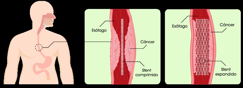 mayadjen's tweet photo. @emyzero86 @eligedisciplina Parece mas un stent, que prácticamente sirve para abrir más el esófago en casos de estenosis. No creas lo que dice el del post. https://t.co/ZVB77aLTX5