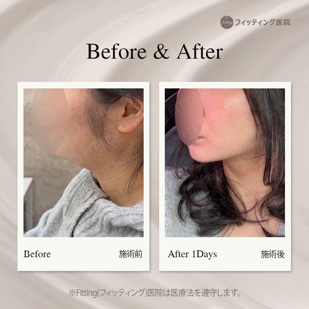 fittingclinicjp's tweet photo. [顔の糸リフト＆脂肪吸引］BEFORE & AFTER（1日）

お顔の施術から1日が経過した症例写真です✨
術後1日目は軽度の腫れや赤みがある時期ですが、フェイスラインの形がすでにしっかりと引き締まり始めている時期です。

BEFORE写真で見られたあご下のたるみや脂肪（二重あご）が的確に改善されたことで、AFTERでは顎から首にかけての境���線がくっきりと現れ、スッキリとしたシャープなシルエットに変化していることが客観的にご確認いただけます😉
現在、皮膚の内側は回復過程にありますが、見た目の上ではすでにリフトアップ効果を実感でき、美しいVラインが完成に近づいています。

「長年悩んでいた二重あごやフェイスラインのたるみをなくしたい」
そのお悩み、フィッティング医院が確かな技術でサポートいたします。

ㅡㅡㅡㅡㅡㅡㅡㅡㅡㅡㅡㅡㅡㅡㅡㅡㅡㅡㅡㅡㅡㅡㅡ
🎥 YouTube
https://t.co/Q3Wm95UMeI
📸 Instagram https://t.co/IhHiccGvpr
🎵 TikTok https://t.co/QvpCA8h6f8
📢 X https://t.co/a5rIKTk0Mg

日本語でのお問い合わせ 📞 +82-10-8295-9793
所在地 : ソウル特別市江南区島山大路124 デヨンビル2階（新沙駅から徒歩2分）

#輪郭整形 #二重あご改善 #小顔整形 #激薄整形 #韓国脂肪吸引 #韓国美���外科 #術後1日 #ビフォーアフター #経過報告 #江南整形 #新沙クリニック #小顔 #横顔美人 #美容整形 #Vライン