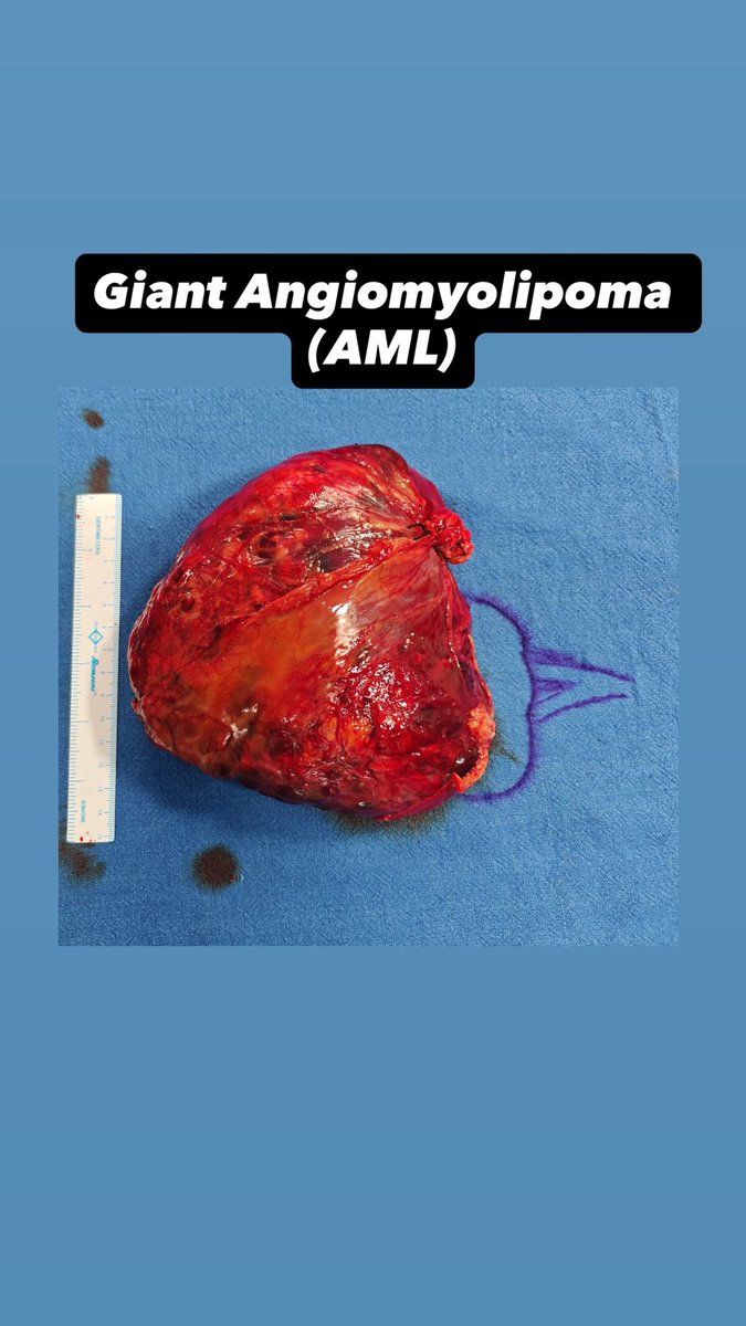Rhtdwl48's tweet photo. 16+ cm AML + Kidney Preservation + Only 14 Minutes of Warm Ischemia

Successfully removed a giant right renal angiomyolipoma (>16 cm) with complete tumor excision while preserving kidney.

#Urology #AML #KidneyTumor #PartialNephrectomy #KidneyPreservation #UroOncology https://t.co/PxskhwGcPl