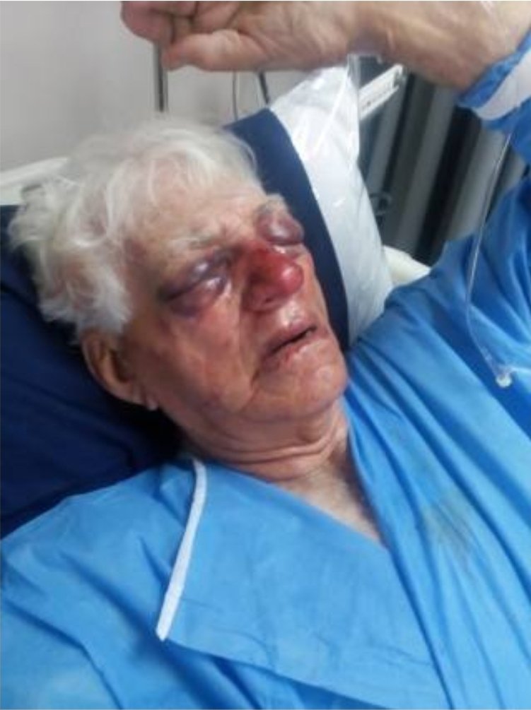 RiseAgainstEvil's tweet photo. Farmer John Byles (81) from the Tadcaster farm near Hartswater in the Northern Cape died months after a vicious farm attack in September 2018.

On the morning of 5 September 2018, around 7am, two unknown attackers overpowered John Byles outside his house on the isolated farm. He was brutally assaulted with a shovel. The attackers struck him repeatedly in the face and head, causing severe injuries including major trauma to his skull and facial bones. He sustained critical head wounds and was left in a serious condition requiring immediate hospitalization.

Despite medical treatment, John Byles suffered ongoing complications from the severe beating and passed away several months later as a direct result of the injuries inflicted during the farm attack.

This is another example of how attackers show no mercy to age or frailty. The assault was part of a pattern of violent home invasions and farm attacks targeting White farming communities, involving gratuitous brutality.

No arrests were reported in the immediate aftermath, and the perpetrators remain at large.