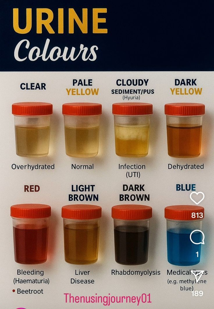 Nyirarukunkz6's tweet photo. Urine colour https://t.co/AFykAY5cvE