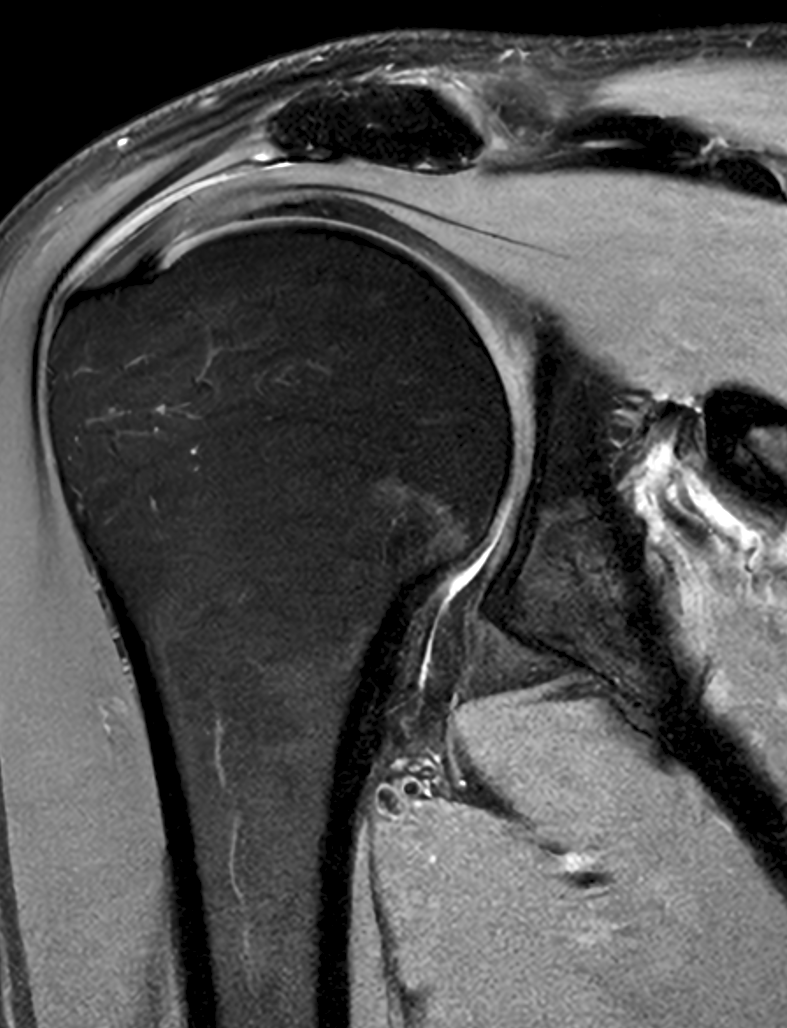 Postulka's tweet photo. 1/

Pacient 40+, lékař. Po škubnutí ramenem vznikly bolesti typické pro subakromiální dráždění.

MR závěr:
 "Zřetelné patologické změny nezjištěny."
Pacient znejistěl:
„Tak proč to vlastně bolí?“

#medicinajedetektivka https://t.co/fmRiKrWamL
