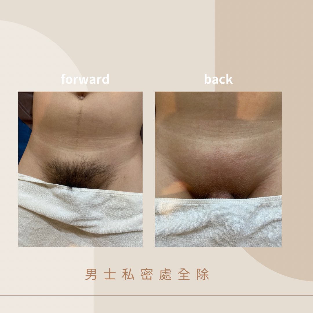 lnnn439579's tweet photo. 除一次會不會不長毛
：任何除毛方式都會長毛
每一次除毛��都會減少
每個人毛髮生長週期不同
沒辦法說除幾次會完全不長毛
但一定會一次比一次少和越來越細

想要偶爾除毛 可以選熱蠟除毛
定期除毛可達半永久無毛選無痛除毛❤️
Ps： 舊客享 85折 
#高雄  #除毛  #按摩 #主頁有預約方式 https://t.co/O8gXy29q4q