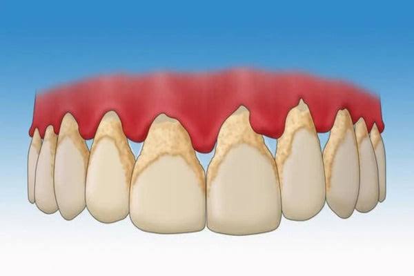 Sainte_Hermine5's tweet photo. Vos dents ne sont pas lisses au passage de la langue ?

C’est la plaque dentaire. Si vous la laissez s'installer, elle se transforme en tartre, et là, c'est le dentiste obligatoire.

Pourtant, il existe un mélange ancestral pour garder un sourire de marbre.🧵 https://t.co/DkwklZT7zK