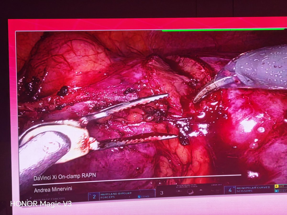 AbdallaDeb's tweet photo. A very strong start to @CILR2026 in #Rome with RAPN by @minerviniandre, who boldly and successfully rotated the right kidney upside down, providing exceptional exposure and access to the tumour.

#KidneyCancer 🧡🎗️ #RCC #RoboticSurgery #RAPN #UroOncology https://t.co/s0k8y43e1J