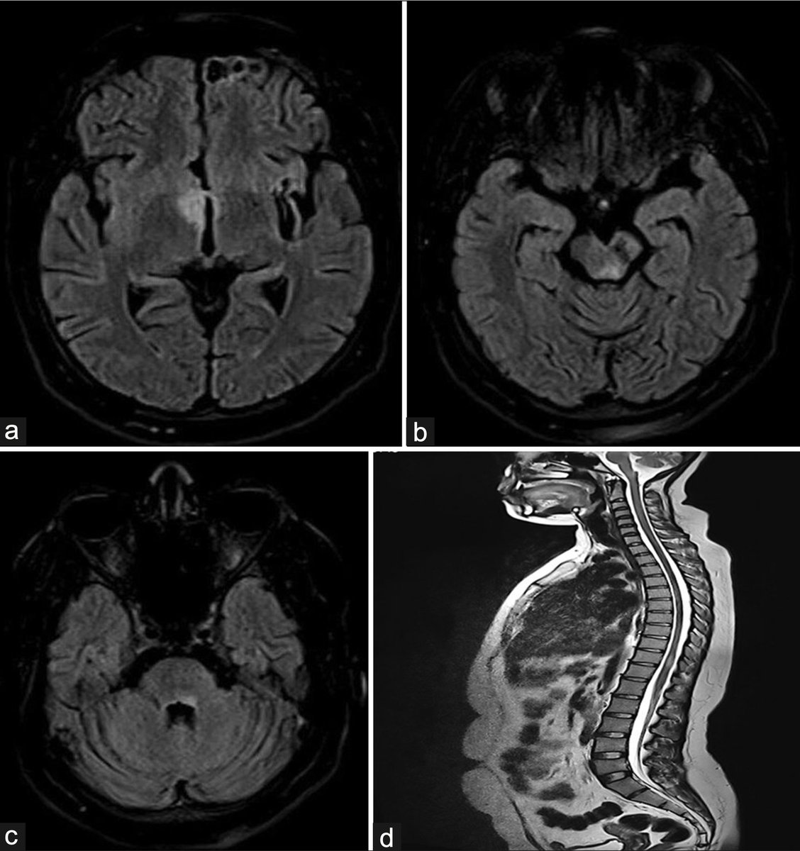 AnnIndAcadNeur's tweet photo. NMOSD can present with narcolepsy as its 1st manifestation. MRI typically shows hypothalamic involvement. Kallolimath et al present one such case emphasising serum aquaporin 4 testing in all such cases. @neuro_ian #NMOSD #Narcolepsy
Link: 10.4103/aian.AIAN_74_18 https://t.co/zgEuJwJmUf