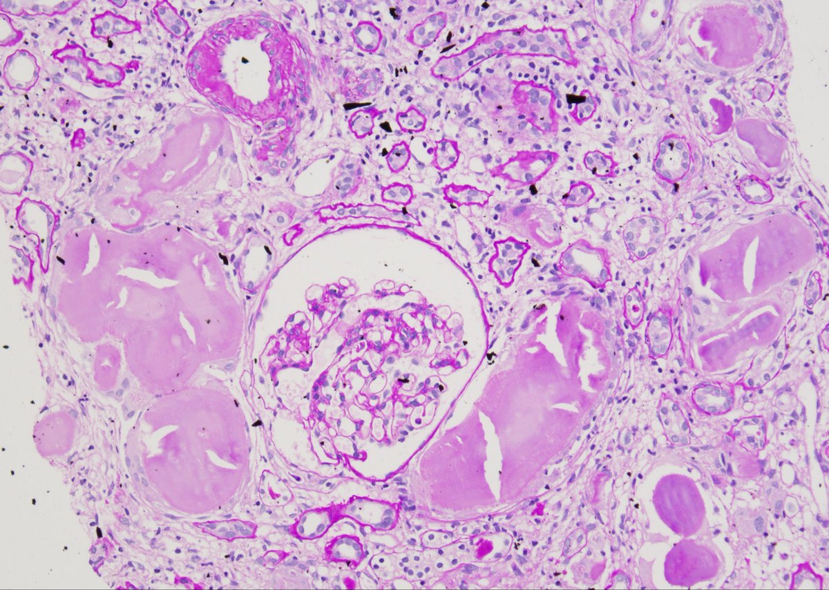 kanishk10246585's tweet photo. 🔬 Spiculated intratubular casts on silver stain, Congo red positivity, and apple-green birefringence point to amyloid cast nephropathy. Paraffin IF confirmed kappa restriction despite negative routine IF.

#RenalPathology #KidneyBiopsy #Amyloidosis #NephPath https://t.co/LmDVEQdbVk