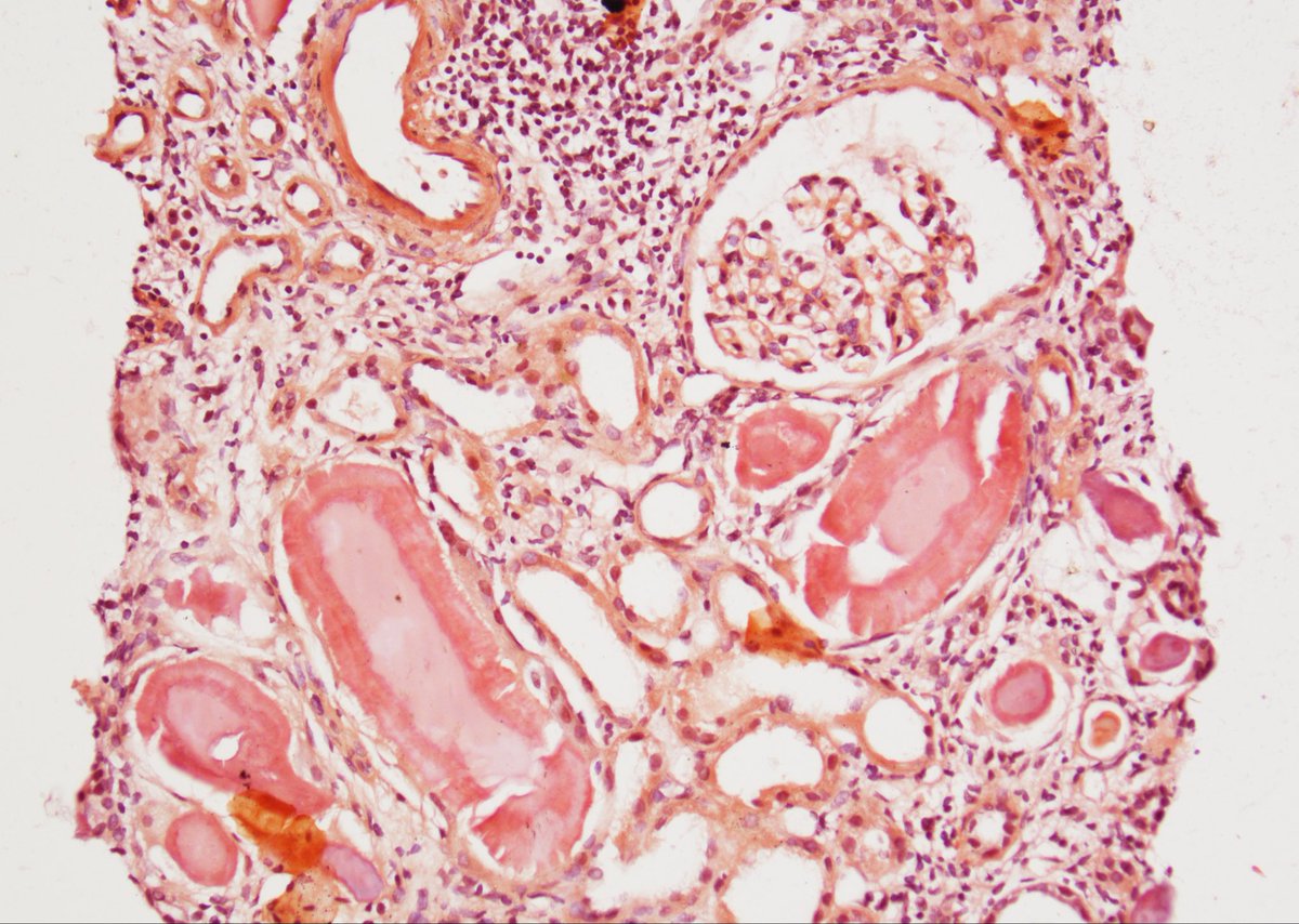 kanishk10246585's tweet photo. 🔬 Spiculated intratubular casts on silver stain, Congo red positivity, and apple-green birefringence point to amyloid cast nephropathy. Paraffin IF confirmed kappa restriction despite negative routine IF.

#RenalPathology #KidneyBiopsy #Amyloidosis #NephPath https://t.co/LmDVEQdbVk
