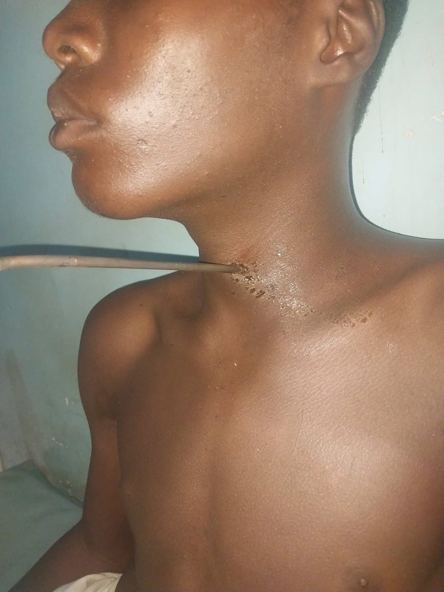Sarki_sultan's tweet photo. Dear Kaduna State Government,

Phone snatchers attacked a young boy, and the estimated cost of his surgery is now over ₦500,000+, all because of a phone worth less than ₦200,000.

I am respectfully calling on the Kaduna State Government to urgently address the growing menace of phone snatching in the state. Many families are losing loved ones to these criminals, and the situation is worsened by the weak justice system. When these suspects are arrested, some are granted bail even before they are taken to court.
I have been in Kaduna Prison and spoken with several of them. Many confidently say that even after arraignment, they will still get bail. Some even believe that if convicted, they will eventually receive amnesty. I have personally seen individuals return to prison two to three times after being released. This is why many of them no longer fear arrest by security agencies. They fear mob action by the community far more than the police or the courts.

Urgent action is needed. During Governor Nasir El-Rufai’s administration, anyone caught in such crimes was made to serve a minimum of seven years in prison. That kind of strong deterrent should be reinstated.
Thank you.

Sarki sultan ✍️