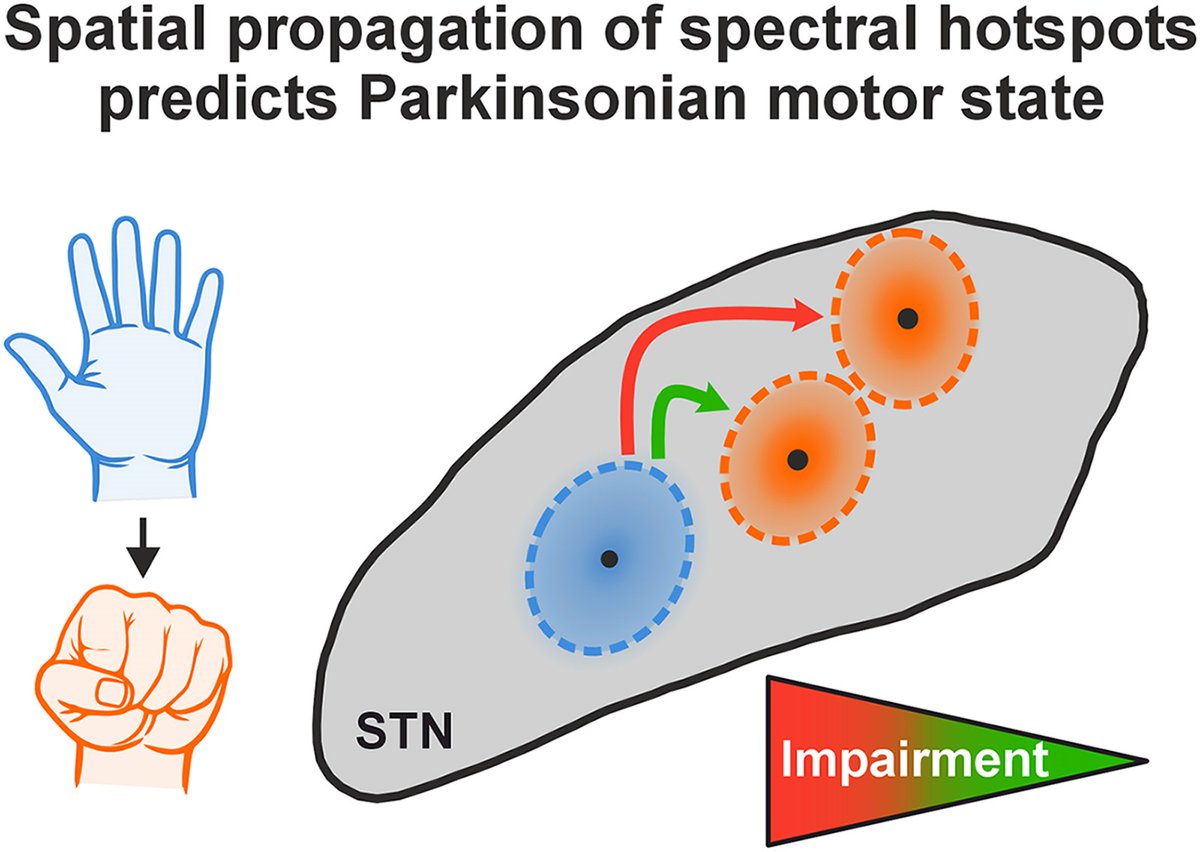 Brain1878's tweet photo. Averna et al. show that movement-related activity in the STN of patients with Parkinson’s disease propagates spatially during motion, with the degree of propagation related to motor impairment and medication response. https://t.co/M27vHei0EZ; https://t.co/tQtm0niZAa https://t.co/A6MyZWVeIK