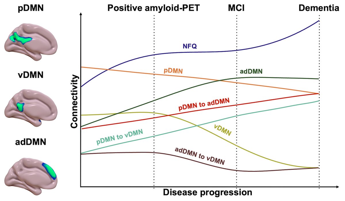 Brain1878's tweet photo. Corriveau-Lecavalier et al. show that patterns of default mode network dysfunction predict future conversion to amyloid positivity, mild cognitive impairment, and dementia, emphasizing the role of network dyshomeostasis in Alzheimer’s disease. https://t.co/B14bNHaYdf https://t.co/LQTW7uXz9v