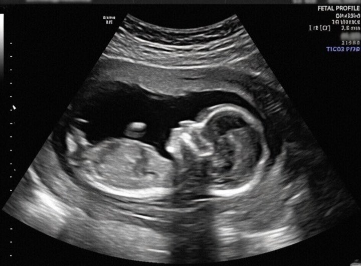 Samsonthegoat25's tweet photo. Nicki Minaj, in her interview yesterday, said:

“I’ve been keeping this to myself for a long time, and I feel now is the right moment to finally say it I’m pregnant for Kenneth Petty.” https://t.co/yQx85ySTeY