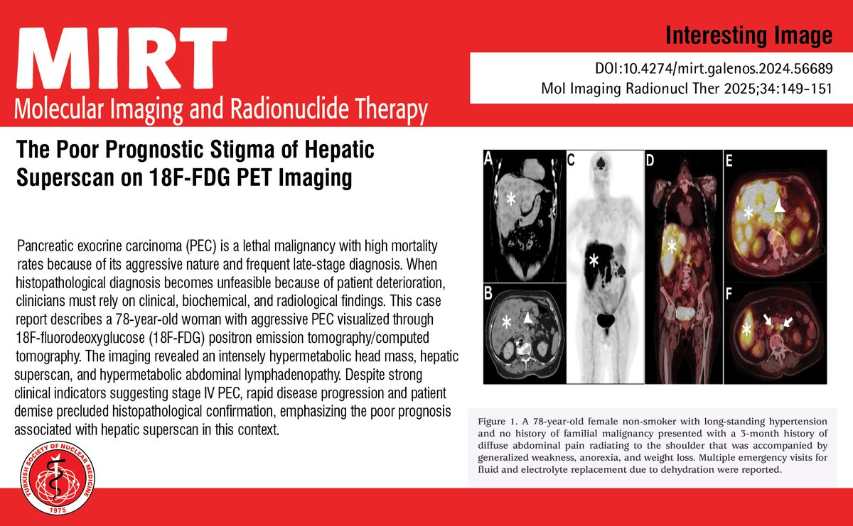 MIRTOfficial's tweet photo. The Poor Prognostic Stigma of Hepatic Superscan on 18F-FDG PET Imaging
You can see the free full text of the research by Dhuha Al-Adhami et al.
Link : https://t.co/YtrC9Qamv3
#Pancreatic #carcinoma #hepatic #superscan #fulminant #metastasis https://t.co/WBZ48Speno