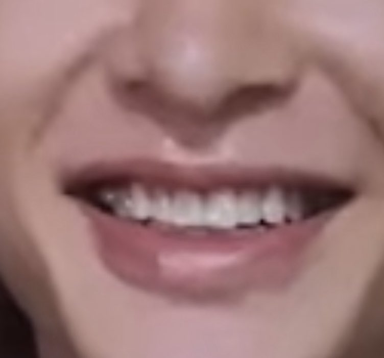 jjinggumiese's tweet photo. Yeah it looks like Invisalign brackets 😭 https://t.co/6rtcwEWNhK