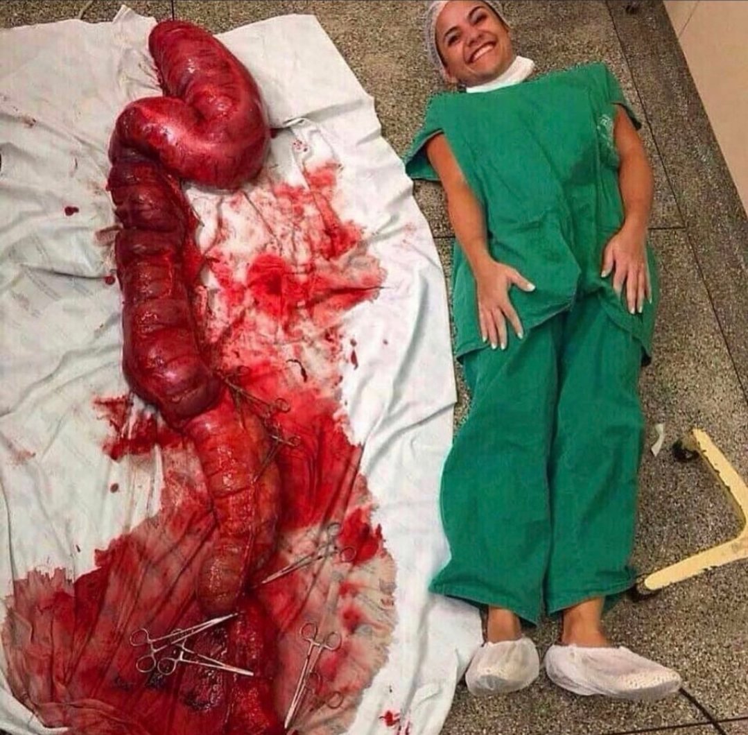 big_show166's tweet photo. صورة بعد أستئصال القولون 

لحالة تُدعى :

تصخم القولون السُمّي Toxic Megacolon 

حالة نادرة الحدوث ، وتحدث خلال أيام وقد تكون قاتلة .

قد تكون أحد مضاعفات أمراض الأمعاء الإلتهابية
Inflammatory Bowel Diseases

وعدة أسباب أخرى https://t.co/dCVoYmyHcs
