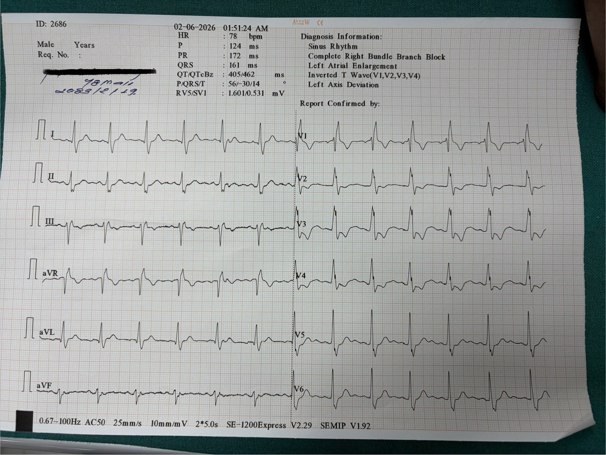 TheTutorMD's tweet photo. 48-year-old male with hypertension presented with 30 minutes of central chest discomfort, dizziness, anxiety, and dry mouth.

BP: 200/100 (R arm), 190/100 (L arm). Other vitals stable.

ECG attached 👇

What are your ECG findings? How would you proceed?

#ECGChallenge #Cardiology https://t.co/vi89IEK9Gf