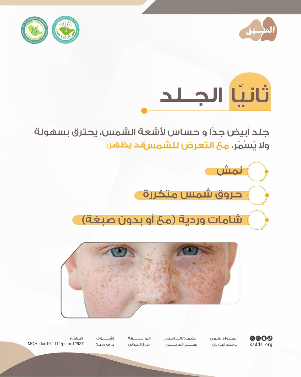 ssdds_org's tweet photo. ما هي علامات وأعراض المهق؟ المهق اضطراب وراثي يؤثر على صبغة الجلد والشعر والعينين، فيظهر عادةً على شكل بشرة شاحبة، وشعر وعيون فاتحة اللون. وقد تصاحبها اضطرابات بصرية مثل حساسية الضوء وضعف الإبصار. تهدف هذه السلسلة إلى توضيح الحقائق العلمية حول اضطراب المهق وتصحيح المفاهيم الخاطئة. 🤎

#المهق
#اليوم_العالمي_للمهق
#albinism
#albinismawareness
#الجمعية_السعودية_لأمراض_وجراحة_الجلد