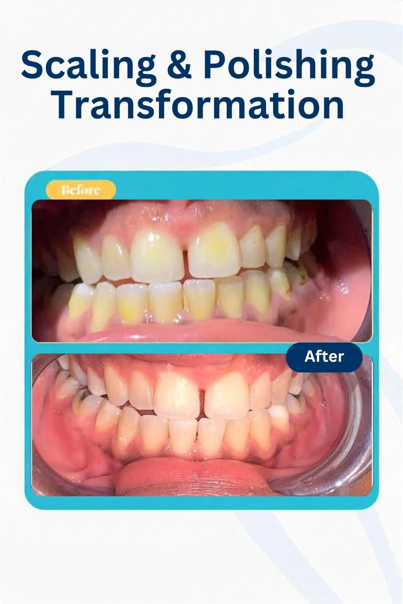 smilesdotcomng's tweet photo. When last did you do a professional dental cleaning?

Scaling &amp; polishing removes plaque, stains and tartar, helping keep your smile healthy and fresh.

We recommend it every 6 months.

Book your appointment today:
📞 +234 901 314 0324
#Smilesdotcom #DentalCleaning #OralHealth https://t.co/YCRX0L8JR6