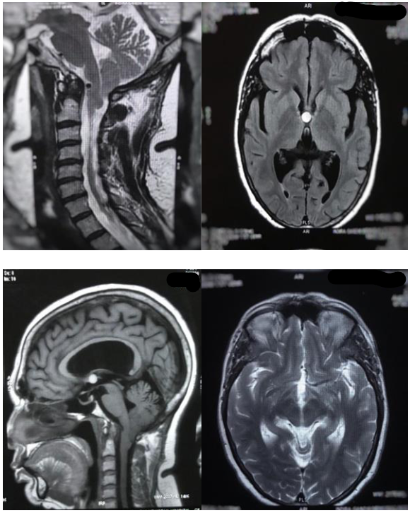 DocNavarrow's tweet photo. 🧑‍⚖️A 59-year-old woman presents with headache, neck pain, upper limb pain, hyperreflexia, and cerebellar signs.

🫣How many abnormalities can you identify on these images? And what are they? https://t.co/Q1xDr0uDAK