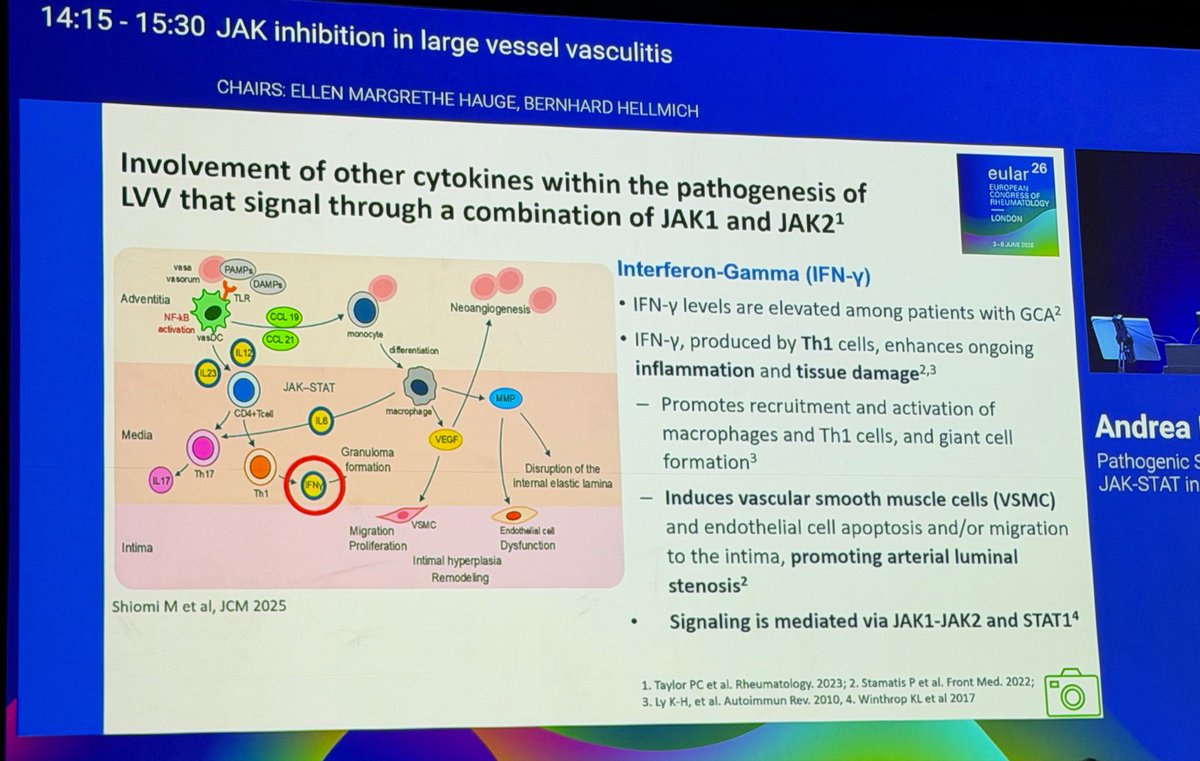 RoxOsler's tweet photo. IL-6 blockade has transformed the treatment of GCA. But is targeting a single cytokine enough? Persistent T-cell infiltrates within the vessel wall, relapses after tocilizumab withdrawal and the role of IFNγ suggest a more complex disease biology. #EULAR2026 https://t.co/9gFVBgX7rX