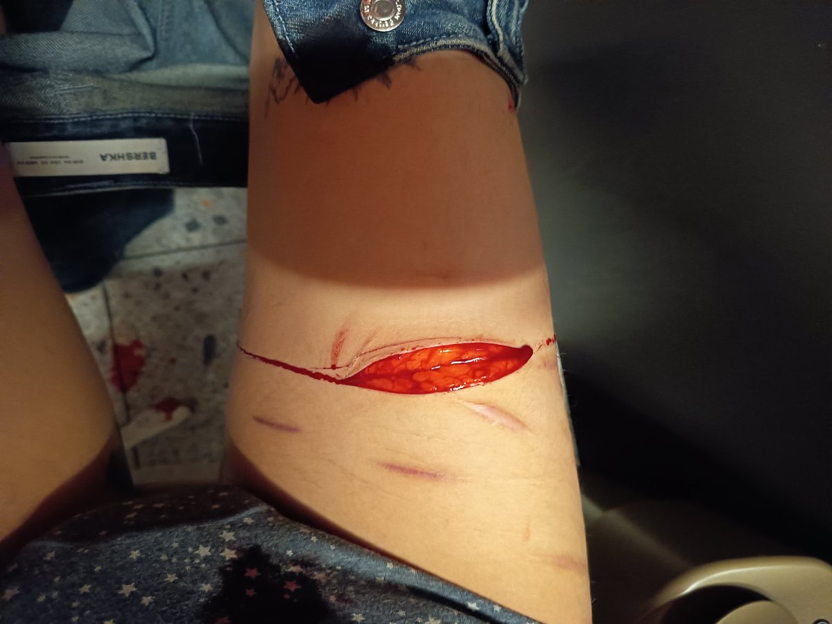 menoeati's tweet photo. Had to get stitched... I feel so fake when I get stitches :( https://t.co/1RhzFzfUcN