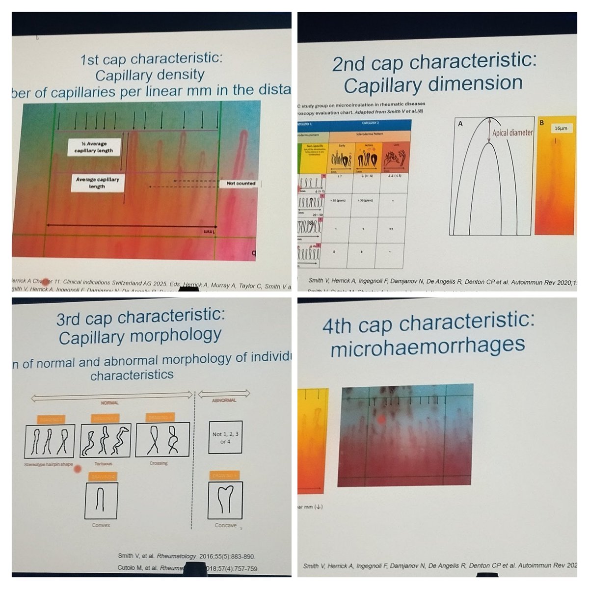 RitasmanB's tweet photo. Nail fold capillaroscope teaching at EULAR 2026  @eular_org @EUSTAR_org https://t.co/FWlzyZZexc