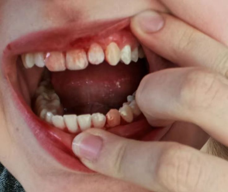 antlercel's tweet photo. ╰┈➤ my YJs teeth headcanons; a thread ｡🦷𖦹°‧ https://t.co/OS34LMPHkM