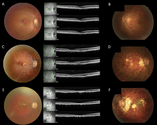 ARVOtvst's tweet photo. Yehong Zhuo et al. from  Zhongshan Ophthalmic Center characterize the fundus changes associated with spontaneous pathologic myopia (PM) in non-human primates (NHPs).
https://t.co/5nV7Pfkuok https://t.co/GFJ2uGJDuI