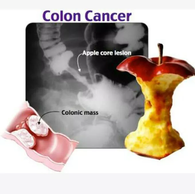 AB_drmd's tweet photo. ✅الـ Apple Core Sign هو علامة إشعاعية كلاسيكية تشوفها في صورة الـ barium enema، وعشان تفهمها صح لازم أول شي تتخيل شكل تفاحة مأكول من وسطها، يعني اللي يصير هو إن الـ colorectal carcinoma وهو سرطان القولون والمستقيم ينمو بشكل حلقي حوالين جدار الأمعاء من كل الجهات ويضيق التجويف الداخلي، ف لما تحقن الـ barium وهو صبغة بيضاء تظهر في الأشعة داخل الأمعاء، يمر من المنطقة الضيقة ويعطيك شكل يشبه بالضبط لب التفاحة اللي أُكلت، يعني من الطرفين الأمعاء طبيعية وعريضة وفي النص في تضيق حاد مع حواف غير منتظمة وأكلة، و هالتضيق سببه إن الورم ينمو من الـ mucosa اللي هي الطبقة الداخلية للأمعاء ويمتد للحيطان و يسبب تقرحات وتدمير في الأنسجة اللي تعطي المظهر الخشن والمتآكل في الصورة، وهذا النوع من النمو يسمى annular constricting lesion، والمنطقة اللي تأثرت عادةً تكون قصيرة ما تتجاوز بضع سنتيمترات وهذا يخليها تشبه أكثر شي لب التفاحة، وهالعلامة مهمة جداً لأنها توجهك مباشرة نحو التشخيص وتفرق بين الـ carcinoma وأمراض ثانية مثل الـ Crohn's disease اللي تعطي تضيق لكن بشكل أطول وأكثر انتظاماً وتسمى string sign، وبعد ما تشوف هالعلامة لازم تأكد التشخيص بالـ colonoscopy مع أخذ biopsy لأن الـ barium enema يريك الشكل بس ما يعطيك التشخيص النسيجي النهائي.