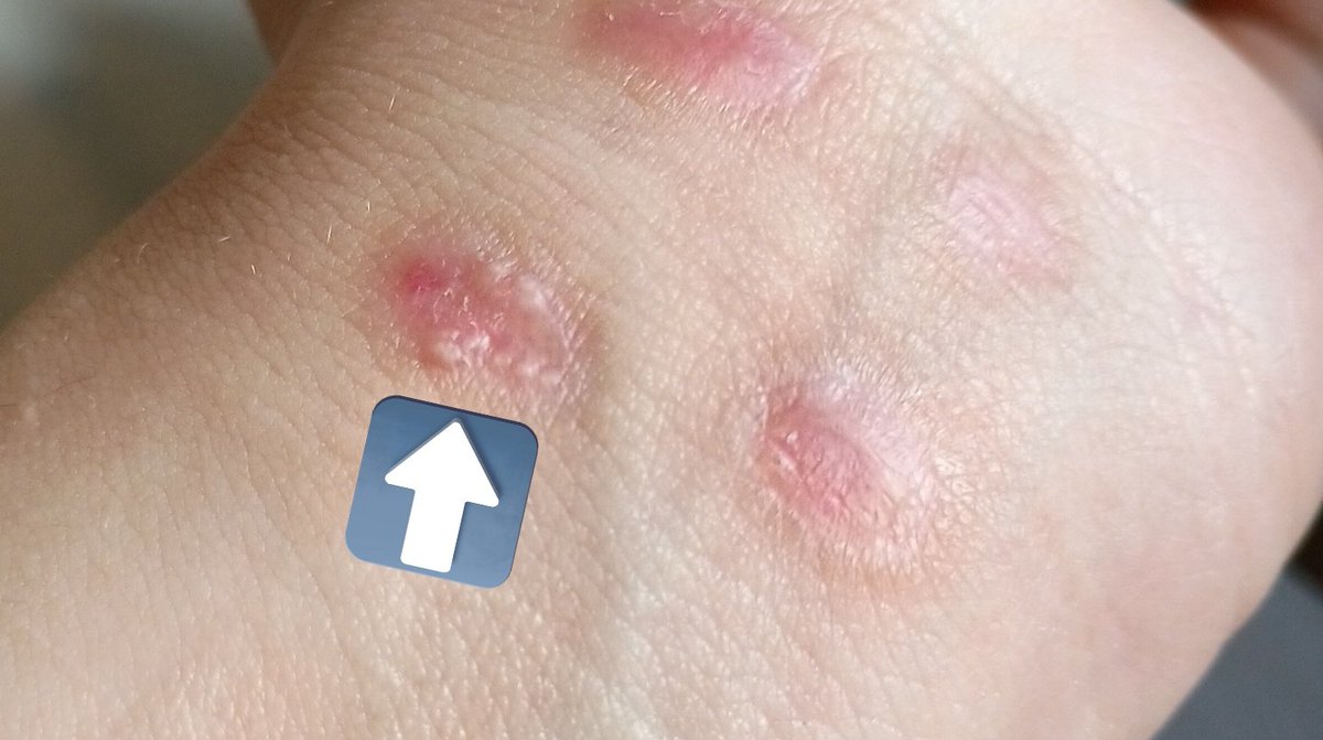 LuckiesShoya's tweet photo. Does anyone know what those dots under my scars are? They appear in some of my burn scars and idk what they are 😭. They're white and hard, the last time they appeared I took them out by reopening the scar but... I just want to know what could it mean that they appear #shtwt https://t.co/2ORBhTsnvP
