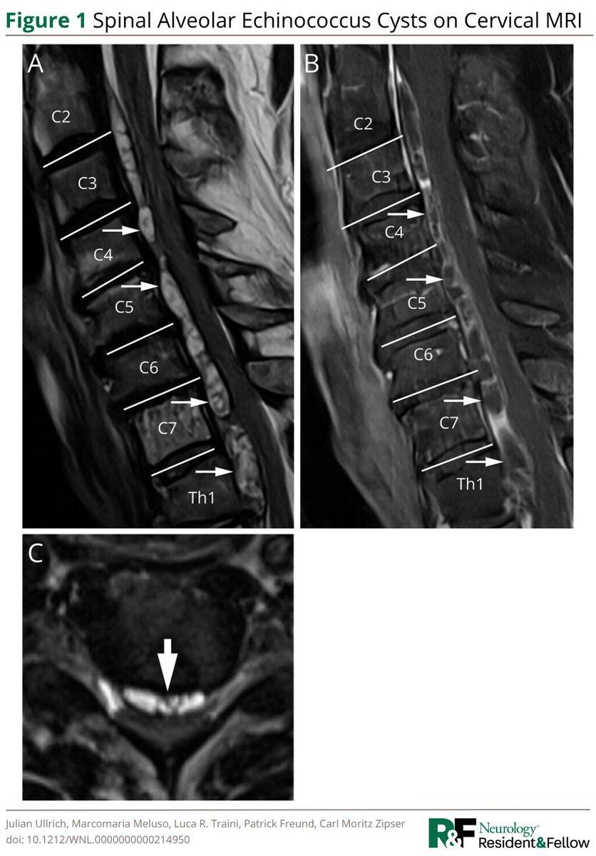 GreenJournal's tweet photo. Teaching #NeuroImage: Cervical Myelopathy Due to Alveolar Spinal Echinococcosis Cysts https://t.co/hoxBLdQnO0

#NeurologyRF https://t.co/RYmKWclE4J