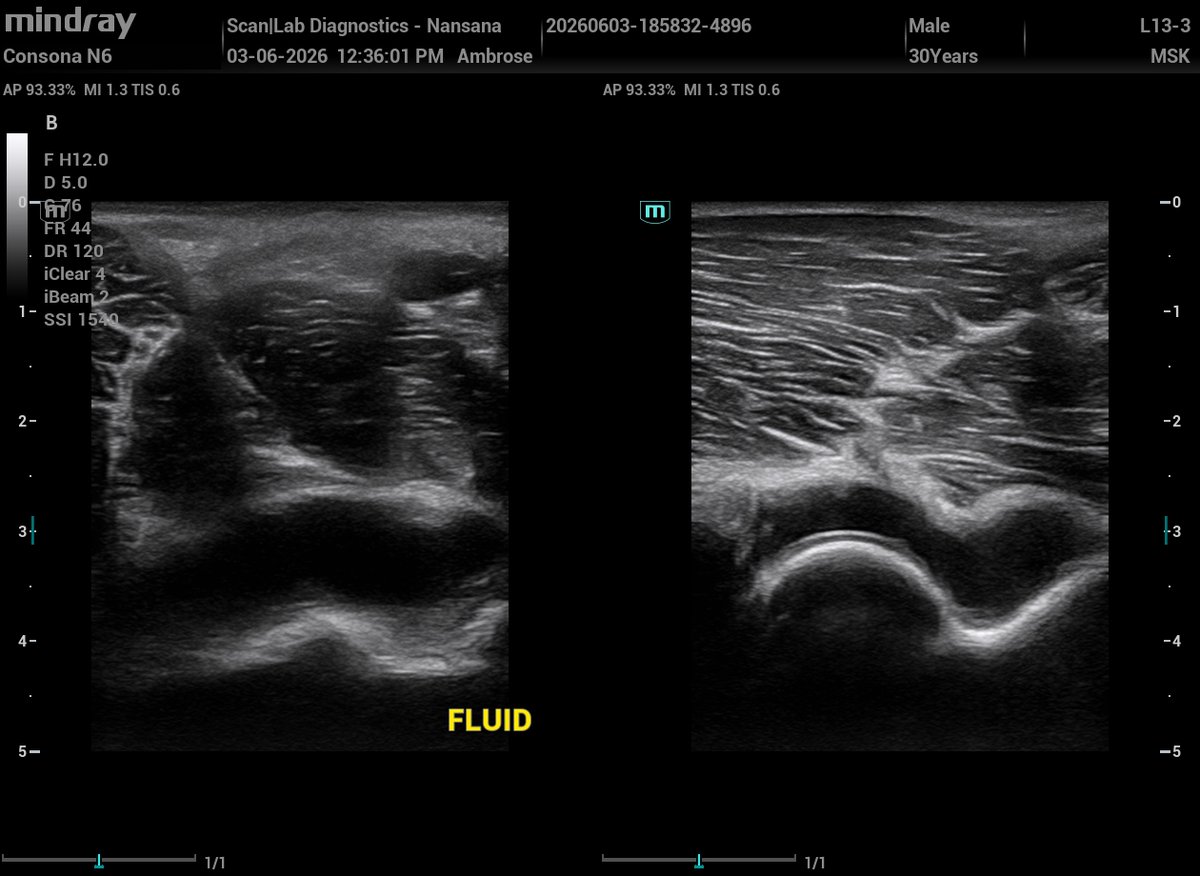ambrose074's tweet photo. Ultrasound speaks. I interpret!
30‑year‑old male presents with 1 month of persistent left‑elbow pain, with no history of trauma.
MSK U/S of the elbow demonstrates multicompartment fluid collections and synovial thickening in the posterior recess.
What pathology does this pattern make you think of and why?   
NOTE: Consider joint recesses, and synovial hypertrophy.
Here are the sonograms 👇👇