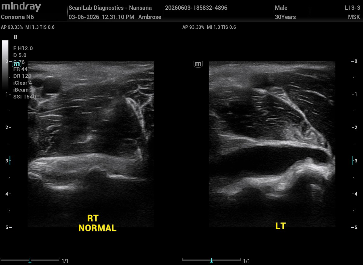 ambrose074's tweet photo. Ultrasound speaks. I interpret!
30‑year‑old male presents with 1 month of persistent left‑elbow pain, with no history of trauma.
MSK U/S of the elbow demonstrates multicompartment fluid collections and synovial thickening in the posterior recess.
What pathology does this pattern make you think of and why?   
NOTE: Consider joint recesses, and synovial hypertrophy.
Here are the sonograms 👇👇