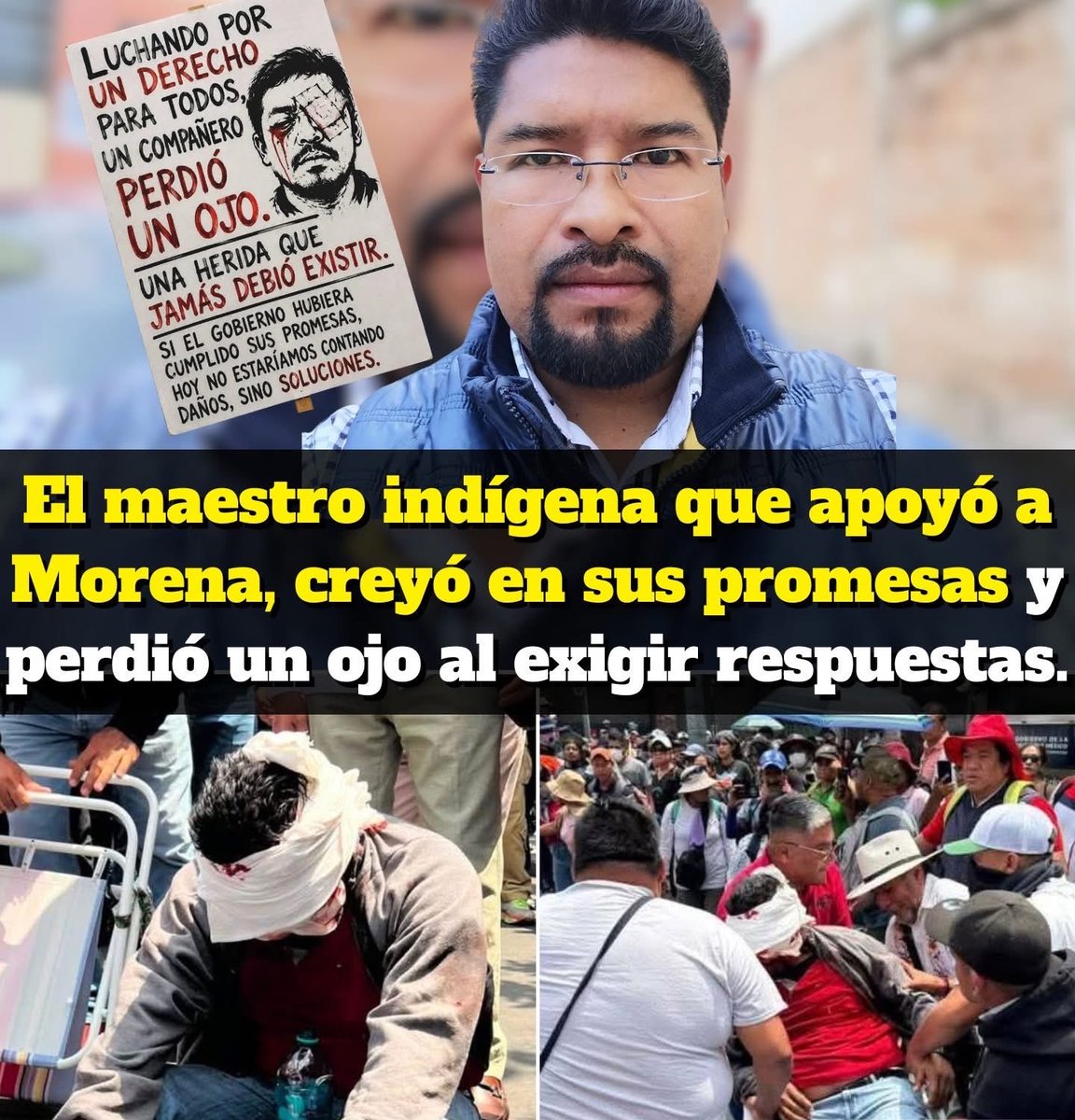 VigiaCiudadano7's tweet photo. Un maestro indígena de la Montaña de Guerrero salió a exigir derechos y regresó con una herida que le cambió la vida.

Se llama Proceso Columbo González González, profesor originario de la región Montaña de Guerrero y supervisor de la zona 22. De acuerdo con Milenio, perdió un ojo durante los enfrentamientos registrados entre integrantes de la CNTE y cuerpos de seguridad en la Ciudad de México.

Desde niño aprendió lo que muchos políticos solo usan en discursos: la injusticia, la carencia y la desigualdad.

Con esfuerzo logró convertirse en maestro y dedicar su vida a enseñar en la Montaña de Guerrero, una zona donde la educación resiste más por vocación que por apoyo del Estado.

Durante años apoyó las luchas sociales de su comunidad. También creyó en el cambio político que prometía justicia para los pueblos olvidados.

Caminó casa por casa, promovió el voto a Morena, organizó brigadas y apoyó a quienes prometieron escuchar al magisterio y a los pueblos originarios.

Hoy, ese maestro terminó perdiendo un ojo mientras protestaba.

Según dirigentes del magisterio disidente citados por Milenio, el profesor fue alcanzado por un proyectil en el rostro durante las movilizaciones de la huelga nacional de la CNTE. La CETEG también informó que otros cuatro maestros guerrerenses resultaron lesionados.

La Fiscalía capitalina ya abrió una carpeta de investigación por lesiones dolosas. 

Mientras tanto, la Secretaría de Seguridad Ciudadana negó haber usado gas, petardos o balas de goma y aseguró que sus elementos solo portaban equipo de protección.

Entonces, ¿Cómo termina un maestro indígena perdiendo un ojo en una protesta por derechos laborales?

Proceso Columbo representa a miles de maestros rurales, indígenas y comunitarios que han sostenido la educación donde el Estado llega tarde, mal o simplemente no llega.

La Montaña de Guerrero no puede seguir siendo recordada solo cuando hay pobreza, tragedia o represión.

Hoy su nombre debe escucharse fuerte: Proceso Columbo González González.

Un maestro indígena de la Montaña, que creyó en el cambio y que hoy exige justicia desde una herida que no se puede esconder...

#CNTE #amorpormexico #Morena #ClaudiaSheinbaum #protesta