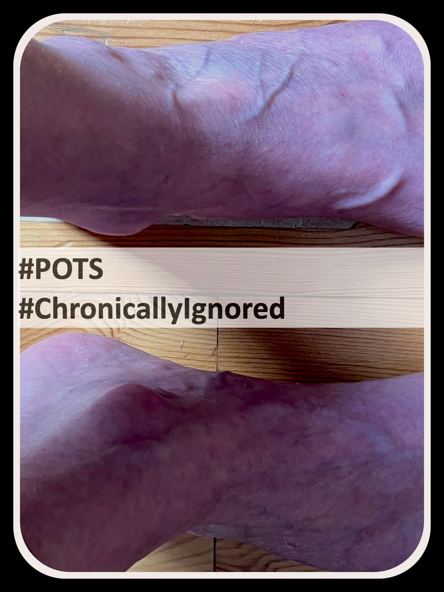 sibylle_berlin's tweet photo. Auch das "blood pooling" muss die Angst vor dem Aufstehen sein, in Verbindung mit #SmallFiber Neuropathie Schädigungen sowieso, doch logisch, oder? 🙃 #POTS
Ja, die meinen das tatsächlich ernst, Christina! @CK65375
Wenn es bloß nicht so tragisch wäre ...
... würde ich drüber lachen.
