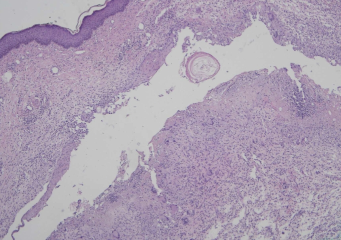 schowardjd's tweet photo. Diagnosis: Cutaneous Mycobacterium abscessus infection associated with a ruptured epidermal inclusion cyst (EIC). 

A punch bx showed suppurative granulomatous dermatitis w/in a scar, raising concern for an infectious process despite -ve PAS, Gram, Fite, & auramine-rhodamine stains. Repeat excisional bx demonstrated a ruptured EIC w/ surrounding granulomatous inflammation. Although bacterial & fungal cultures were -ve, AFB tissue culture grew M. abscessus, establishing the dx of a cutaneous rapidly growing nontuberculous mycobacterial (NTM) infection coexisting with a ruptured EIC.   

The lesion was completely excised, & susceptibility-guided therapy w/ azithromycin was administered for 3 mos (macrolide-sensitive, tetracycline-resistant isolate), resulting in complete clinical resolution.  

DDx: deep fungal infection (sporotrichosis, phaeohyphomycosis, blastomycosis), cutaneous leishmaniasis, foreign-body granuloma, granuloma annulare, morphea / localized scleroderma, atrophoderma, cutaneous sarcoidosis, dermatofibroma.  

🔑 Chronic, tx-refractory cutaneous lesions w/ granulomatous inflammation should prompt consideration of NTM infection, even when special stains are -ve, as cx may be required for definitive dx.