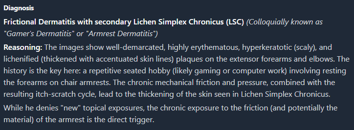 schowardjd's tweet photo. Diagnosis: Frictional lichenification (lichen simplex chronicus) 2/2 chronic mechanical pressure & repetitive friction from chair armrests.

Further hx revealed that the eruption waxed & waned w/ the frequency of the patient's seated hobby of gaming & the condition of the chair armrests. He routinely rested & rubbed his forearms against worn, inadequately padded armrests for prolonged periods, often with significant sweating, producing repetitive friction at the exact sites of involvement.

The morphology and distribution of the lesions corresponded closely to these contact points, supporting a friction-induced dermatosis. Similar activity-related dermatoses have been described in association w/ prolonged gaming and other repetitive recreational activities, including friction-induced eccrine hidradenitis & controller-related hyperkeratotic lesions. In this case, chronic pressure, friction, and moisture led to localized lichenification of the elbows & dorsal forearms.

Mx consisted of behavioral & ergonomic modifications, including improved armrest padding and minimizing repetitive friction, along w/ topical corticosteroids & emollients. These measures resulted in progressive symptomatic improvement and resolution of the lichenified plaques.

<GPT-5.5 & Claude Opus 4.8>