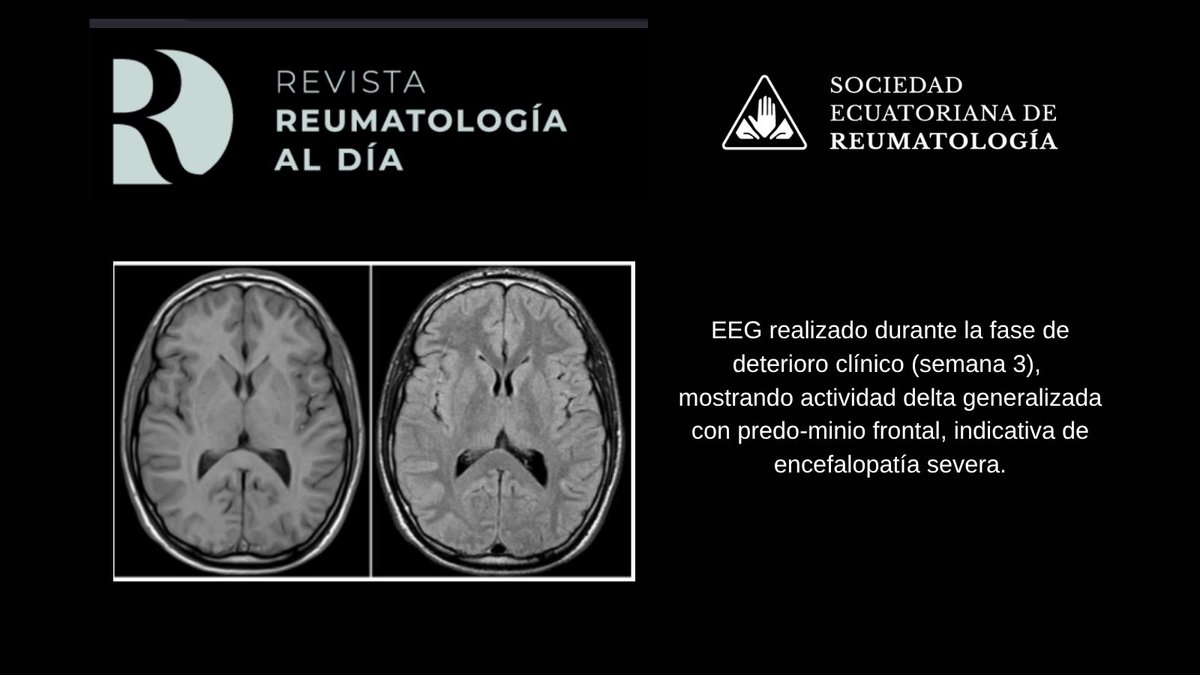 SocEcReumato's tweet photo. 𝐄𝐧𝐜𝐞𝐟𝐚𝐥𝐢𝐭𝐢𝐬 𝐚𝐮𝐭𝐨𝐢𝐧𝐦𝐮𝐧𝐞 𝐩𝐨𝐫 𝐚𝐧𝐭𝐢𝐜𝐮𝐞𝐫𝐩𝐨𝐬 𝐀𝐧𝐭𝐢 𝐍𝐌𝐃𝐀-𝐑, 𝐩𝐨𝐬𝐭𝐞𝐫𝐢𝐨𝐫 𝐚 𝐢𝐧𝐟𝐞𝐜𝐜𝐢𝐨́𝐧 𝐩𝐨𝐫 𝐂𝐨𝐯𝐢𝐝-𝟏𝟗 𝐞𝐧 𝐩𝐞𝐝𝐢𝐚𝐭𝐫𝐢́𝐚: 𝐀 𝐩𝐫𝐨𝐩𝐨́𝐬𝐢𝐭𝐨 𝐝𝐞 𝐮𝐧 𝐜𝐚𝐬𝐨

🧠⚡️ ¿Psicosis? ¿Epilepsia? ¿Encefalitis viral? A veces, el diagnóstico correcto es una encefalitis autoinmune.
#ReumatologíaEcuador #SaludEcuador #Rheumatology
#Autoimmune #encephalitis
 
https://t.co/QvdsIr7ZJi

👦 𝐂𝐚𝐬𝐨 𝐜𝐥𝐢́𝐧𝐢𝐜𝐨: 𝐚𝐝𝐨𝐥𝐞𝐬𝐜𝐞𝐧𝐭𝐞 𝐝𝐞 𝟏𝟕 𝐚𝐧̃𝐨𝐬, 𝐩𝐫𝐞𝐯𝐢𝐚𝐦𝐞𝐧𝐭𝐞 𝐬𝐚𝐧𝐨, 𝐜𝐨𝐧 𝐚𝐧𝐭𝐞𝐜𝐞𝐝𝐞𝐧𝐭𝐞 𝐝𝐞 𝐢𝐧𝐟𝐞𝐜𝐜𝐢𝐨́𝐧 𝐫𝐞𝐜𝐢𝐞𝐧𝐭𝐞 𝐩𝐨𝐫 𝐂𝐎𝐕𝐈𝐃-𝟏𝟗 🦠 𝐪𝐮𝐞 𝐢𝐧𝐢𝐜𝐢𝐚 𝐜𝐨𝐧:

🚨 Convulsiones tónico-clónicas 🚶‍♂️ Ataxia 😡 Agitación psicomotriz 🗣️ Alteraciones conductuales 😵‍💫 Deterioro progresivo del sensorio
📌 Estudios iniciales: 🧠 RM cerebral NORMAL., 🧪 PCR virales y tóxicos NEGATIVOS,  💉 IgM SARS-CoV-2 positiva ⚡️ EEG: progresión hacia encefalopatía severa, 🧬 Anti-NMDA positivo en LCR

🚑 𝐏𝐄𝐑𝐋𝐀 𝐂𝐋𝐈́𝐍𝐈𝐂𝐀:

Todo adolescente con:
⚡️ convulsiones + 😵‍💫 alteración conductual + 🧠 encefalopatía subaguda
➡️ debe hacer pensar en encefalitis anti-NMDA-R. 

💥 𝐓𝐑𝐀𝐓𝐀𝐌𝐈𝐄𝐍𝐓𝐎

1️⃣ Primera línea inmunomoduladora: 💉 Metilprednisolona 1 g/día x 3 días    +   🧪 IGIV 2 g/kg total (400 mg/kg/día x 5 días)

🎯 𝐎𝐛𝐣𝐞𝐭𝐢𝐯𝐨:

⬇️ Frenar inflamación cerebral
🛡️ Modular respuesta autoinmune temprana 

⚠͟️͟ ͟P͟e͟r͟o͟ ͟e͟l͟ ͟p͟a͟c͟i͟e͟n͟t͟e͟ ͟p͟e͟r͟s͟i͟s͟t͟i͟ó͟ ͟c͟o͟n͟:͟

😡 Agitación severa; ⚡️ Actividad encefalopática, 🧠 Desconexión progresiva, y movimientos anormales persistentes

➡️ 𝐒𝐞 𝐜𝐨𝐧𝐬𝐢𝐝𝐞𝐫𝐨́ 𝐄𝐍𝐂𝐄𝐅𝐀𝐋𝐈𝐓𝐈𝐒 𝐑𝐄𝐅𝐑𝐀𝐂𝐓𝐀𝐑𝐈𝐀.

 Escalamiento terapéutico: 🧬 Rituximab 375 mg/m² semanal x 4 semanas 🎯 Depleción de linfocitos B productores de autoanticuerpos

⚠️⚠️ 𝐒𝐢𝐧 𝐫𝐞𝐬𝐩𝐮𝐞𝐬𝐭𝐚 𝐜𝐥𝐢́𝐧𝐢𝐜𝐚 𝐬𝐮𝐟𝐢𝐜𝐢𝐞𝐧𝐭𝐞. ⚠️⚠️

3️⃣ Terapia de rescate: ☣️ Ciclofosfamida 500 mg/m² 🎯 Inmunosupresión más profunda en contexto de alta actividad autoinmune

📈 𝐄𝐯𝐨𝐥𝐮𝐜𝐢𝐨́𝐧:

✅ Recuperó conexión con el medio; ✅ Mejoró la marcha ✅ Recuperó alimentación oral ✅ Mejoría funcional significativa

🔬 ¿𝐐𝐮𝐞́ 𝐞𝐧𝐬𝐞𝐧̃𝐚 𝐞𝐬𝐭𝐞 𝐜𝐚𝐬𝐨?

🦠 SARS-CoV-2 puede actuar como gatillante inmunológico
🧠 Una RM normal NO excluye encefalitis autoinmune
⚡️ El EEG puede reflejar progresión fisiopatológica
💉 La refractariedad temprana obliga a escalar inmunoterapia rápidamente 

𝐘 𝐍𝐎 𝐎𝐋𝐕𝐈𝐃𝐄𝐒 𝐥𝐨𝐬 𝐝𝐢𝐚𝐠𝐧𝐨́𝐬𝐭𝐢𝐜𝐨𝐬 𝐞𝐫𝐫𝐨́𝐧𝐞𝐨𝐬 𝐦𝐚́𝐬 𝐟𝐫𝐞𝐜𝐮𝐞𝐧𝐭𝐞𝐬 𝐞𝐧 𝐥𝐚 #𝐄𝐧𝐜𝐞𝐟𝐚𝐥𝐢𝐭𝐢𝐬 #𝐀𝐮𝐭𝐨𝐢𝐧𝐦𝐮𝐧𝐞:
1️⃣ Trastorno neurológico funcional 2️⃣ Demencia neurodegenerativa 3️⃣ Enfermedad psiquiátrica 4️⃣ Síndrome cognitivo inespecífico 5️⃣ Neoplasias 6️⃣ Trastorno convulsivo no mediado por mecanismos inmunes 7️⃣ Enfermedades #Infecciosas 8️⃣ #MELAS 9️⃣ Otros
⚠️ Reconocer estas condiciones es clave para evitar retrasos diagnósticos y terapéuticos.
#Encefalitis #AntiNMDA #Neuroinmunología
📚 Síguenos para más medicina basada en datos reales @SocEcReumato  @RevReumDia