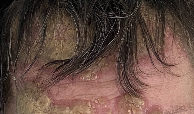 schowardjd's tweet photo. A man in his 40s w/ untreated HIV presented w/ severe palmoplantar keratoderma, nail dystrophy, dactylitis, & numerous well-demarcated dull-red hyperkeratotic to cone-shaped plaques involving the extremities, scalp, ears, & face. Labs showed profound immunosuppression (CD4 count 5 cells/µL), pancytopenia, & -ve syphilis serologies.

What’s your DDx❔
