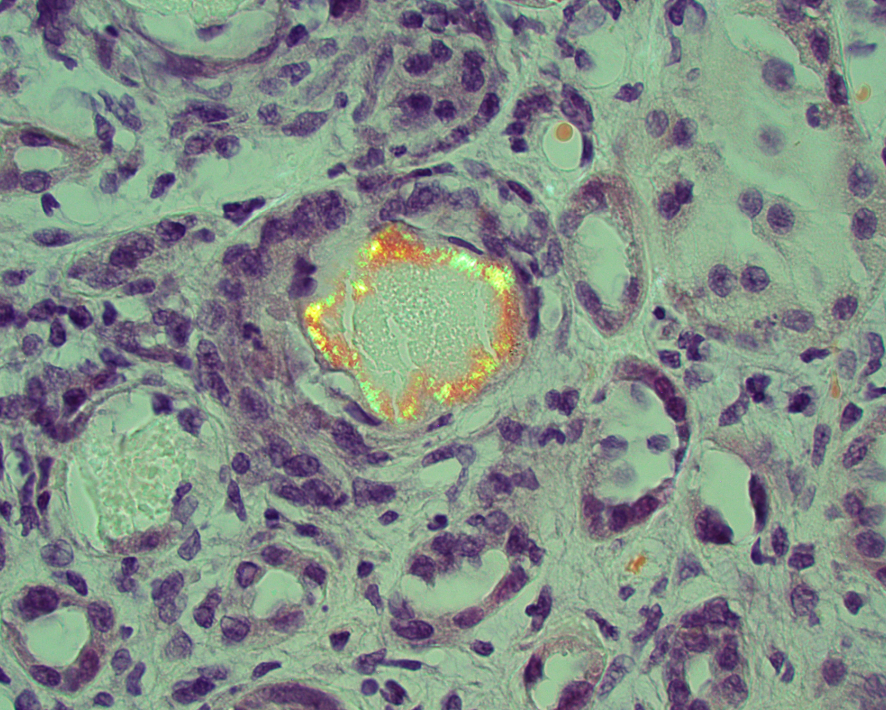JZRenalPath's tweet photo. Sometime the casts have eyelashes. Amyloidogenic variant of light chain cast nephropathy. #renalpath #nephrology #pathtwitter https://t.co/RZ4OWaH9iI